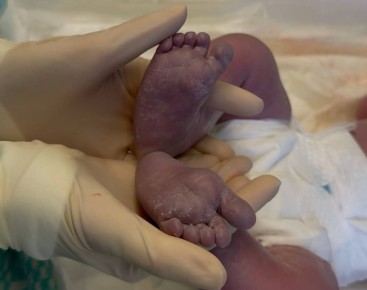 Врачи перинатального центра провели ювелирное кесарево сечение и подарили калининградке седьмого ребенка