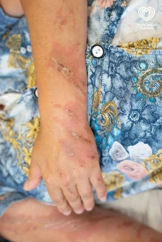 Красивый, но опасный: женщина попала в больницу с ожогами после встречи с ясенцем Красивый, но опасный: женщина попала в больницу с ожогами после встречи с ясенцем