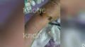 «Я теперь боюсь ходить по улицам»: калининградка получила тяжёлый перелом после столкновения с самокатом